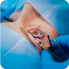 Cirurgia refrativa - Karina Tinoco